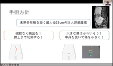 2026年6月23日 第40回「10代患者と産婦人科～卵巣腫瘍手術における術式選択」